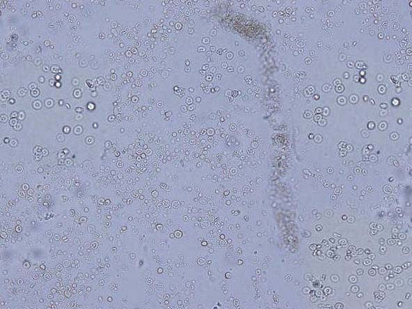 五、中毒性腎病尿沉渣像